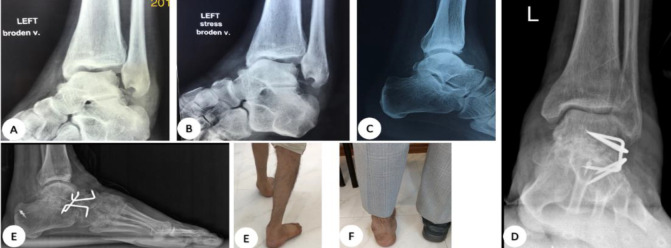 Beyond Drop Foot: A Spectrum-Based surgical Approach to Flaccid Foot Paralysis.