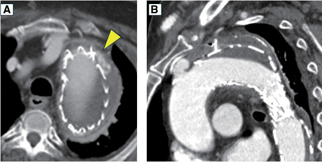 A Case of Rectal Cancer Discovered Following the Occurrence of a Stent-Graft Infection with <i>Streptococcus gallolyticus</i> after Thoracic Endovascular Aortic Repair.