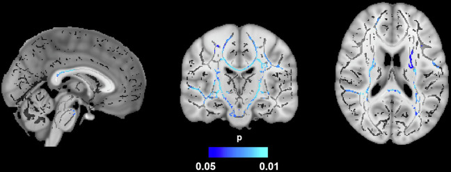 Identifying obesity and dementia risk: body adiposity and neural connectivity in cognitively normal, mid-life adults.