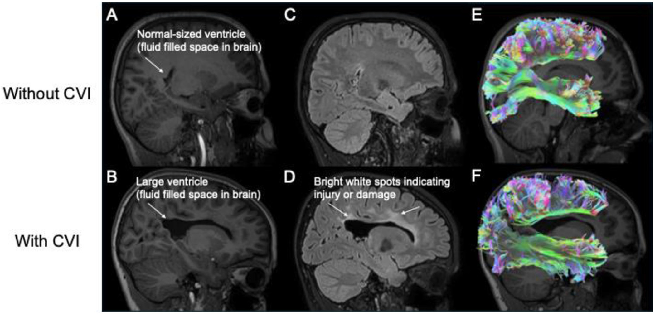 CEREBRAL VISUAL IMPAIRMENT: WHEN THE EYES CAN SEE BUT THE BRAIN DOES NOT FIND.