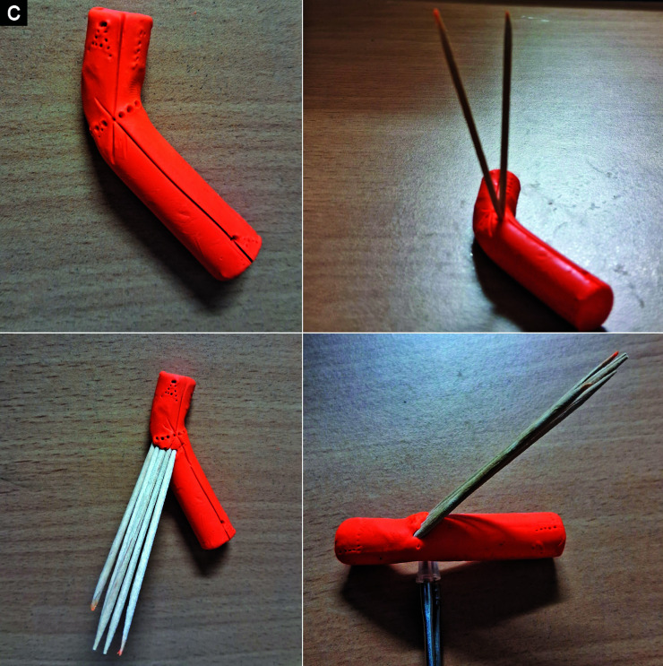 What is the Geometric Rule that Guides Accurate Vertical Orientation of the Single-cut Inclined Osteotomy in a Combined Angulation-rotation Deformity of Long Bone?