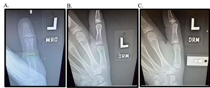 Clinical Insights and Management of Pediatric Bennett-Equivalent Fractures: Case Report and Literature Review.