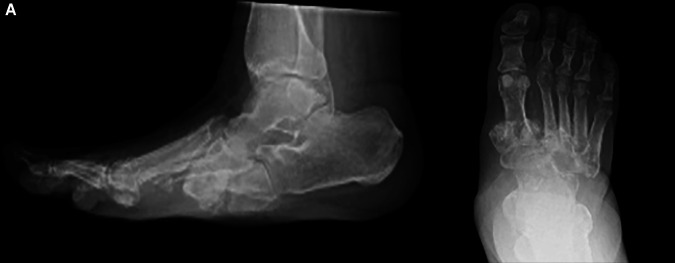 Ischaemic Charcot Midfoot Reconstruction Combined with Lateral Tibial Cortex Transverse Transport: Case Report.