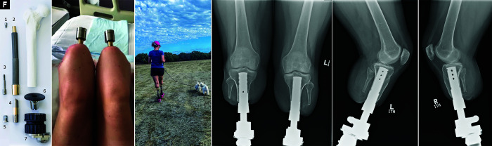 Transcutaneous Osseointegration for Amputees as a Result of Sepsis Management: A Case Series of Nine Patients with a Mean Follow-up of 4 Years.