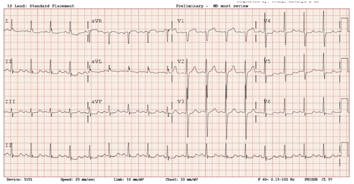 Myocardial Infarction Masking: A Rare Case of Coronary-Subclavian Steal Syndrome.