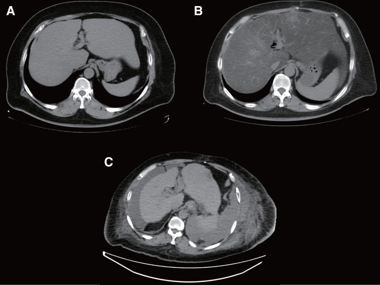Liver Transplantation for Metabolic Dysfunction-Associated Steatotic Liver Disease after Pancreaticoduodenectomy.