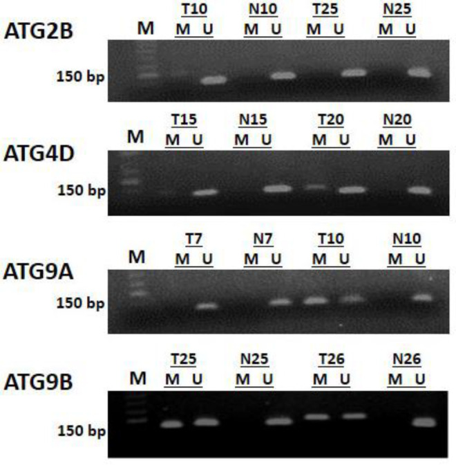 The methylation-expression correlation of autophagy-related genes in colorectal cancer patients from southern Iran.