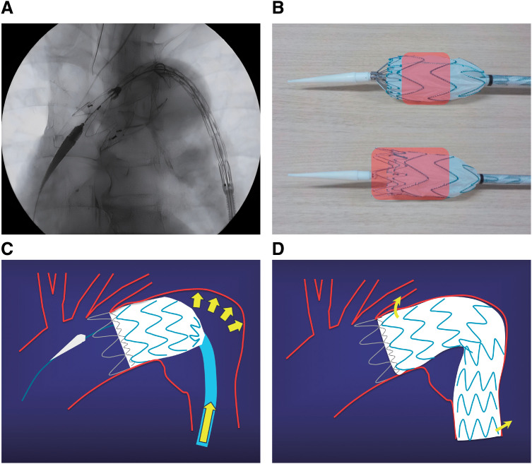 Early Tip Capture Release and Push-Up Technique Using the Valiant Stent Graft System for Aortic Arch Aneurysms.