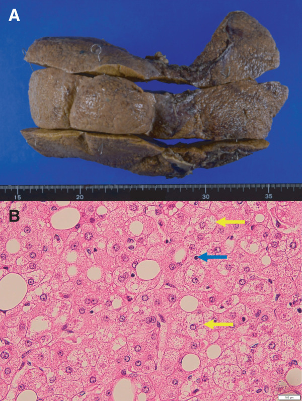 Liver Transplantation for Metabolic Dysfunction-Associated Steatotic Liver Disease after Pancreaticoduodenectomy.