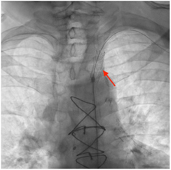 Myocardial Infarction Masking: A Rare Case of Coronary-Subclavian Steal Syndrome.