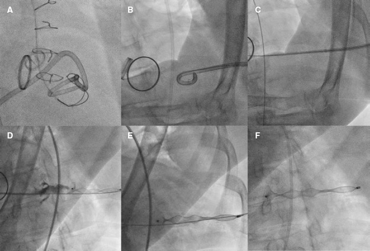 Percutaneous closure of left ventricular puncture after thoracentesis.