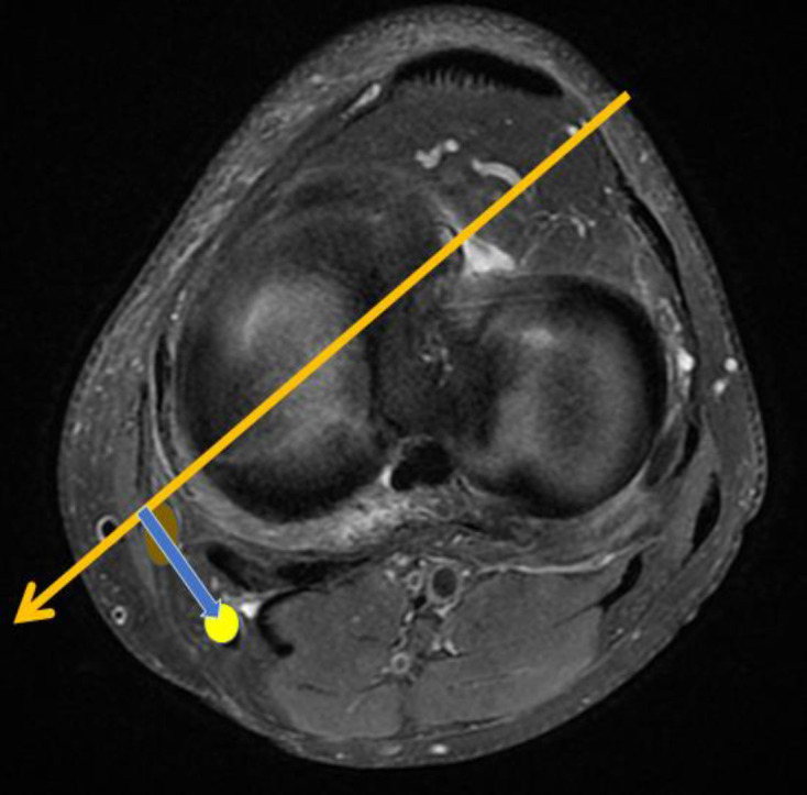 MRI-Based Assessment of the Common Peroneal Nerve in ACL-Injured Versus Normal Knees: Implications for Inside-Out Lateral Meniscus Repair.