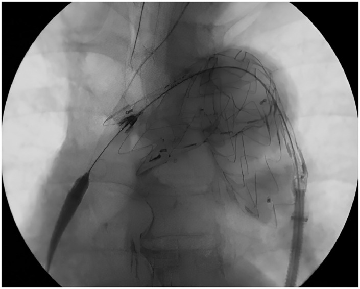 Early Tip Capture Release and Push-Up Technique Using the Valiant Stent Graft System for Aortic Arch Aneurysms.