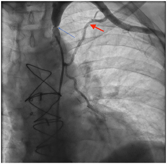 Myocardial Infarction Masking: A Rare Case of Coronary-Subclavian Steal Syndrome.