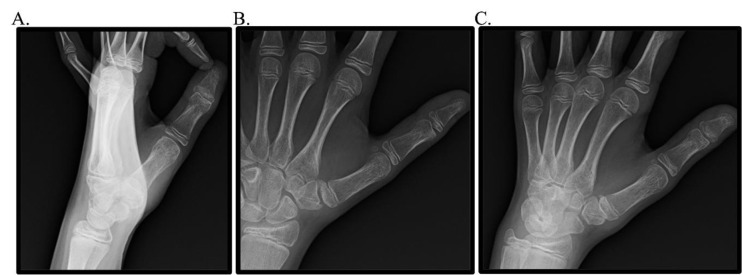 Clinical Insights and Management of Pediatric Bennett-Equivalent Fractures: Case Report and Literature Review.