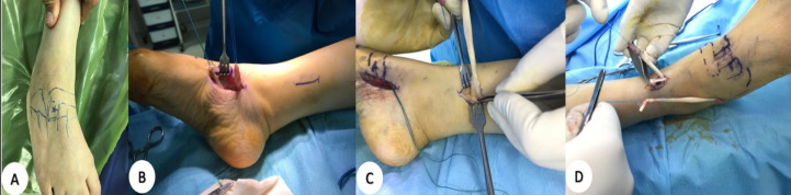 Beyond Drop Foot: A Spectrum-Based surgical Approach to Flaccid Foot Paralysis.