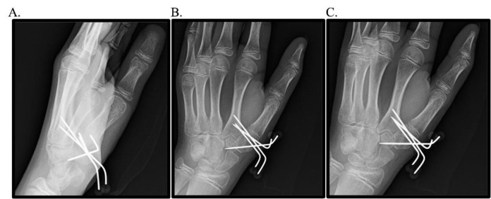 Clinical Insights and Management of Pediatric Bennett-Equivalent Fractures: Case Report and Literature Review.