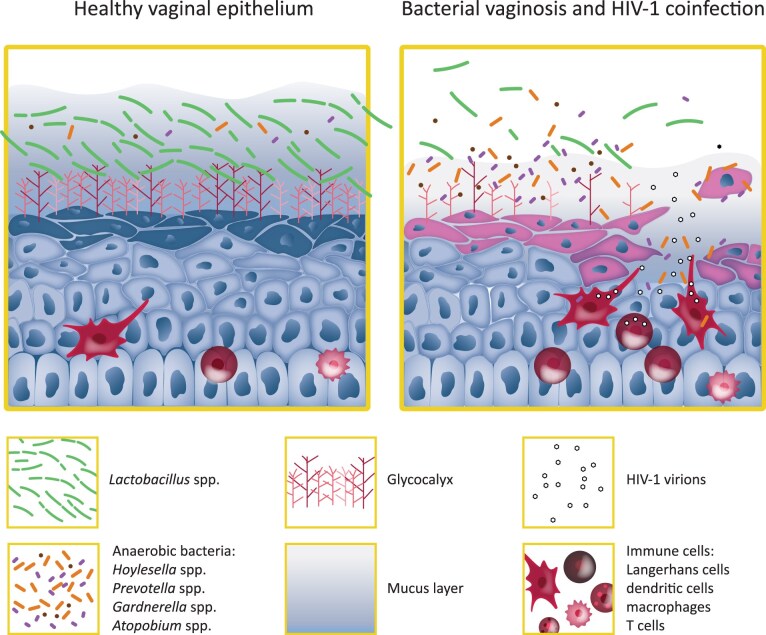 Impact of bacterial vaginosis on sexually transmitted viral infections: a bacterial point of view.