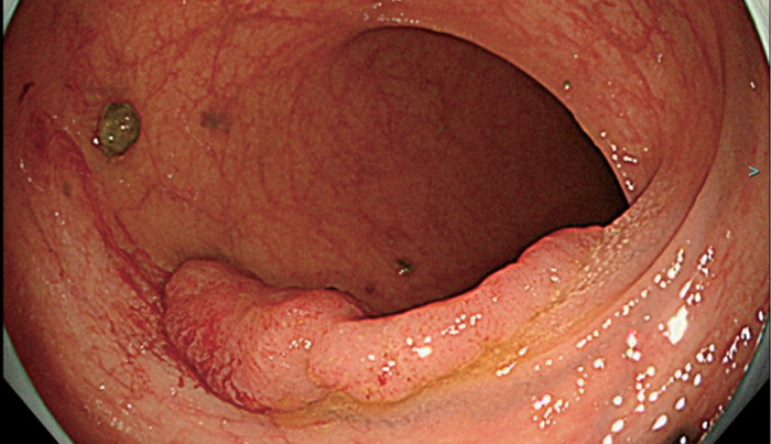A Case of Rectal Cancer Discovered Following the Occurrence of a Stent-Graft Infection with <i>Streptococcus gallolyticus</i> after Thoracic Endovascular Aortic Repair.