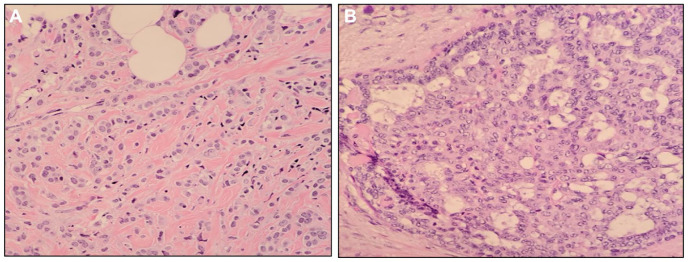 Hereditary Cancer Syndromes in Familial Breast Cancer: Insights Into Proactive Gastric Cancer Surveillance.