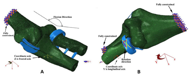 Effects of Prosthesis Shape and Material on the Contact Mechanics of Elbow Joints Following Radial Head Arthroplasty: An In-Silico Investigation.