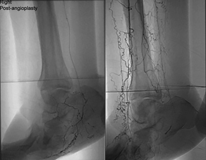 Ischaemic Charcot Midfoot Reconstruction Combined with Lateral Tibial Cortex Transverse Transport: Case Report.
