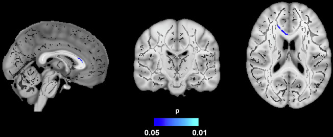 Identifying obesity and dementia risk: body adiposity and neural connectivity in cognitively normal, mid-life adults.