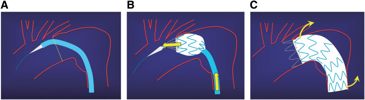 Early Tip Capture Release and Push-Up Technique Using the Valiant Stent Graft System for Aortic Arch Aneurysms.