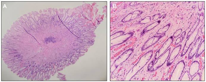 Hereditary Cancer Syndromes in Familial Breast Cancer: Insights Into Proactive Gastric Cancer Surveillance.