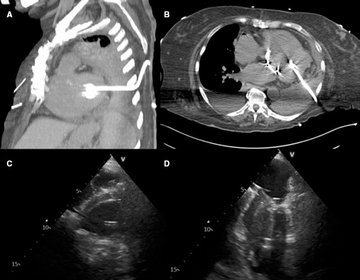 Percutaneous closure of left ventricular puncture after thoracentesis.