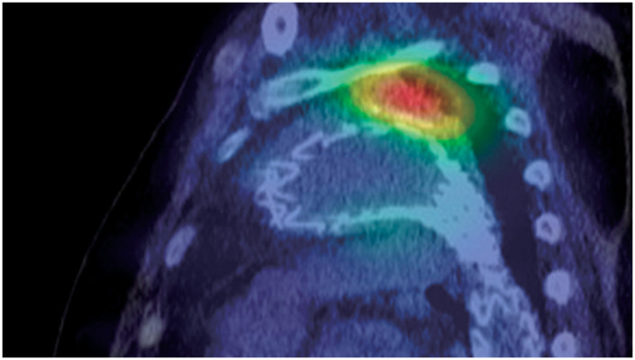 A Case of Rectal Cancer Discovered Following the Occurrence of a Stent-Graft Infection with <i>Streptococcus gallolyticus</i> after Thoracic Endovascular Aortic Repair.