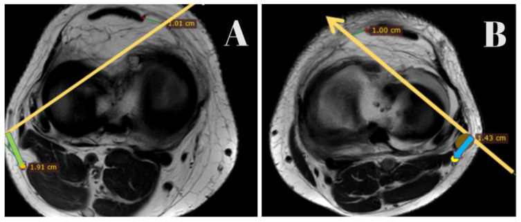 MRI-Based Assessment of the Common Peroneal Nerve in ACL-Injured Versus Normal Knees: Implications for Inside-Out Lateral Meniscus Repair.