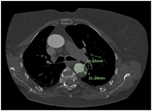 Stanford Type B Aortic Dissection in a Patient With Osteogenesis Imperfecta: A Case Report.