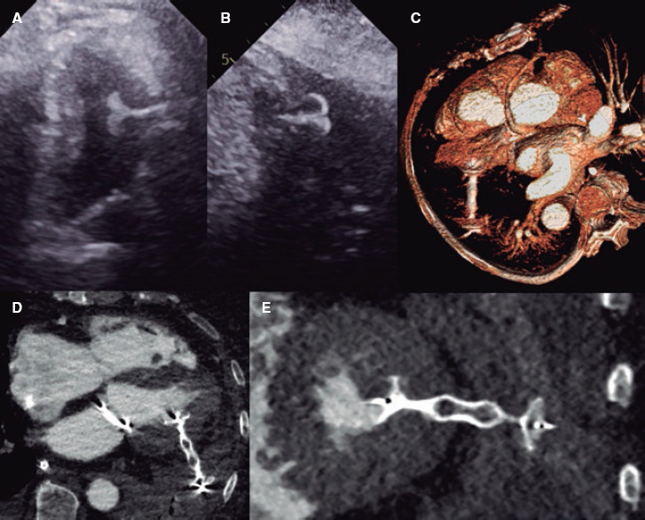 Percutaneous closure of left ventricular puncture after thoracentesis.