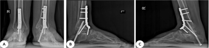 Beyond Drop Foot: A Spectrum-Based surgical Approach to Flaccid Foot Paralysis.