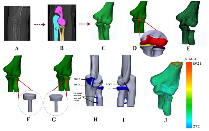 Effects of Prosthesis Shape and Material on the Contact Mechanics of Elbow Joints Following Radial Head Arthroplasty: An In-Silico Investigation.