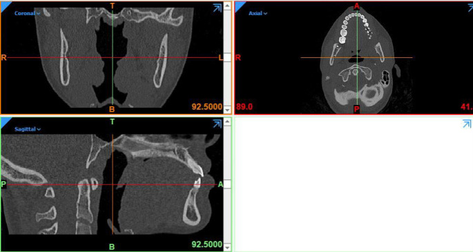 Qualitative Comparison of Stress Distribution of Different Fixation Techniques of Sagittal Split Ramus Osteotomy (SSRO) in Mandibular Setback Surgery in Asymmetric Cases Using Three-Dimensional Finite Element Analysis (FEA).