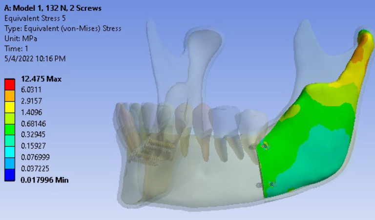 Qualitative Comparison of Stress Distribution of Different Fixation Techniques of Sagittal Split Ramus Osteotomy (SSRO) in Mandibular Setback Surgery in Asymmetric Cases Using Three-Dimensional Finite Element Analysis (FEA).