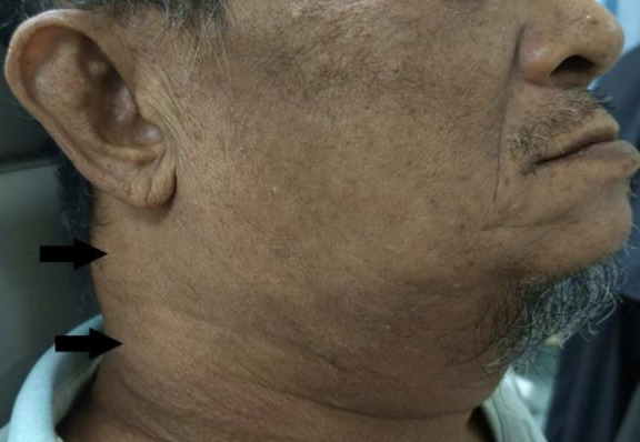 Ipsilateral Oropharyngeal and Cervical Lymph Node Tuberculosis Simulating Oropharyngeal Malignancy with Regional Lymph Node Metastasis: A Case Report.