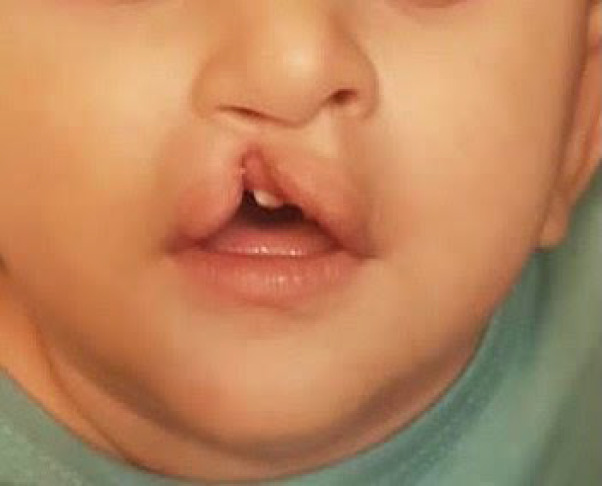 Cleft Lip Techniques and Surgical Outcome in Patients Referred To Abuzar Children's Hospital in Ahvaz, Southern Iran.