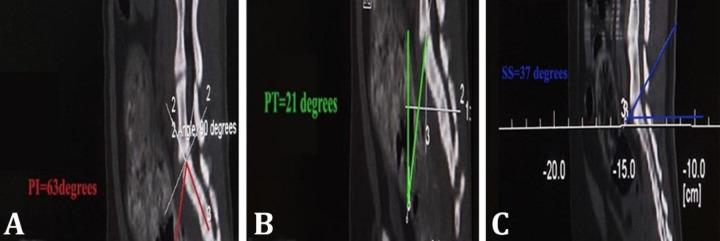 The study of spinopelvic parameters measurement by computed tomography in Scottish cats.