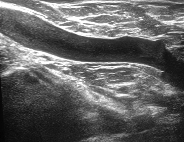 Incidentally Detected McCleery Syndrome during Handheld Breast Ultrasound.