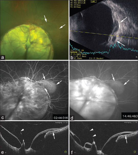 Retinal detachments associated with choroidal colobomas.