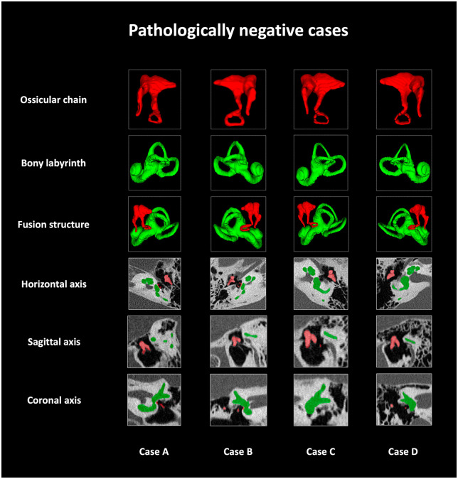 Artificial intelligence model for automatic 3-dimensional reconstruction of ossicular chain and bony labyrinth from high-resolution CT.