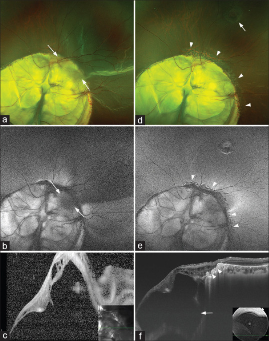 Retinal detachments associated with choroidal colobomas.