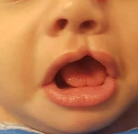 Cleft Lip Techniques and Surgical Outcome in Patients Referred To Abuzar Children's Hospital in Ahvaz, Southern Iran.