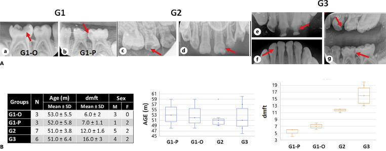 Microbiome in Early Childhood Caries: Caries Severity-Dependent Insights.