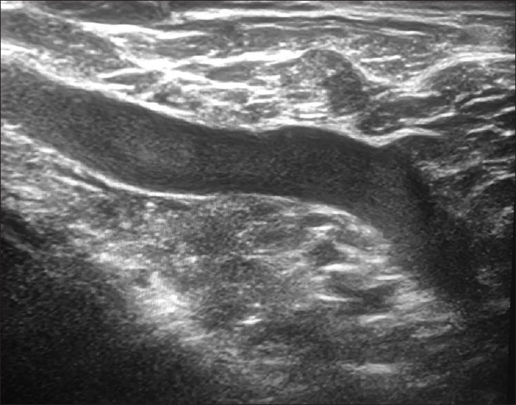 Incidentally Detected McCleery Syndrome during Handheld Breast Ultrasound.