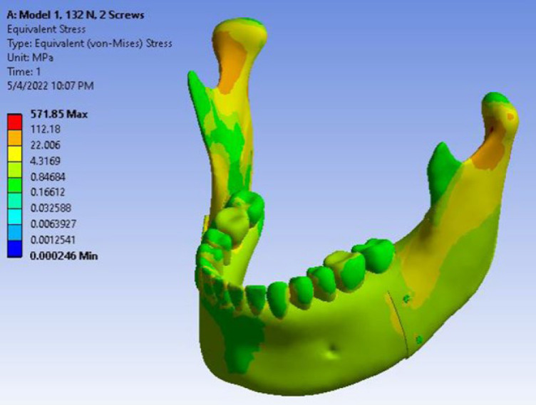 Qualitative Comparison of Stress Distribution of Different Fixation Techniques of Sagittal Split Ramus Osteotomy (SSRO) in Mandibular Setback Surgery in Asymmetric Cases Using Three-Dimensional Finite Element Analysis (FEA).