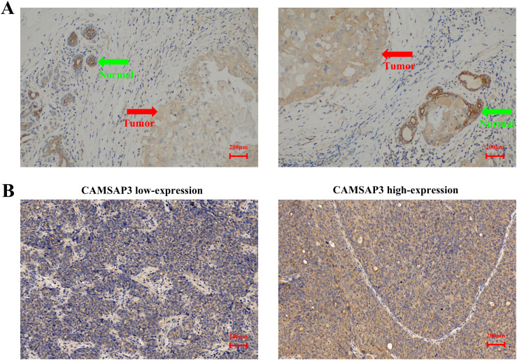 CAMSAP3 Suppresses Breast Cancer Metastasis and Serves as an Independent Prognostic Marker.